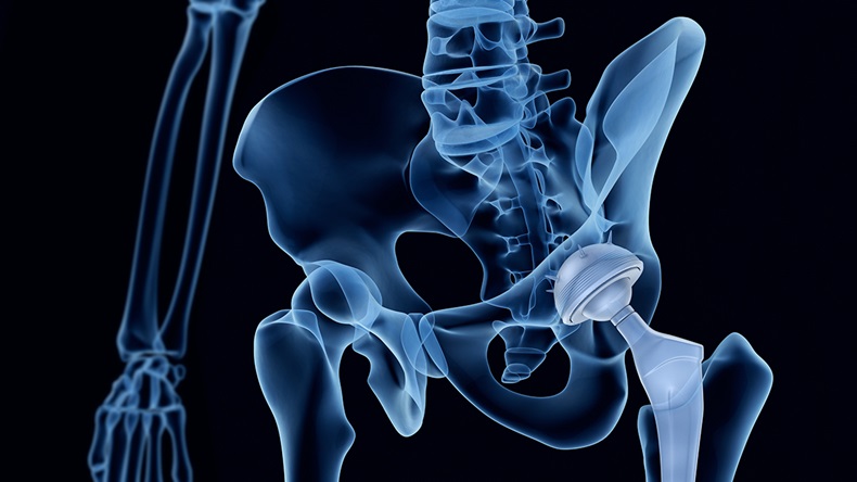Hip replacement (Alex Mit/Shutterstock.com)